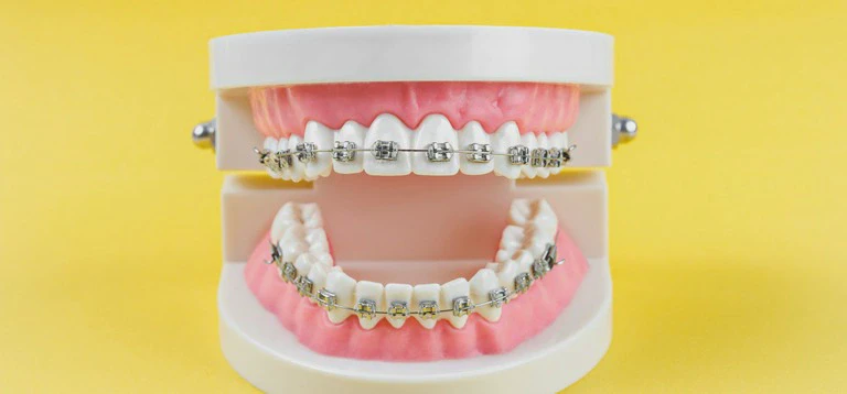 nakładka na&nbsp;zęby