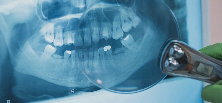 rtg zębów