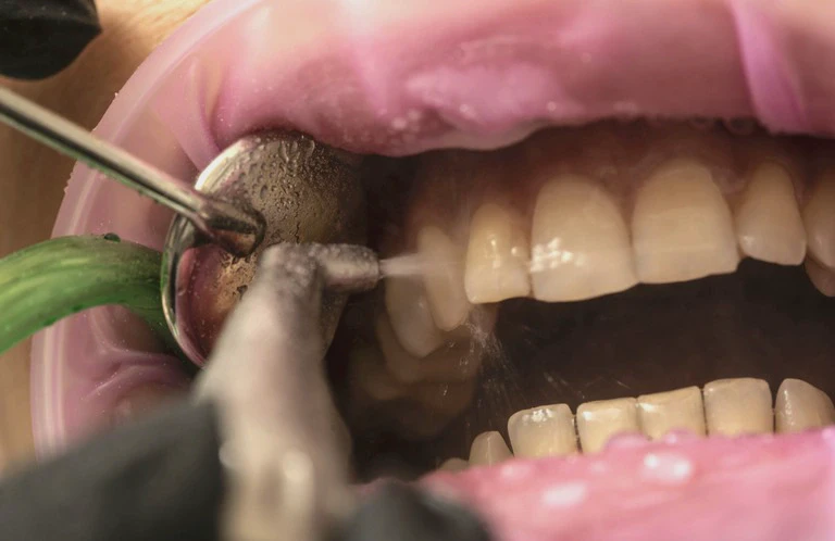 Higienizacja zębów
